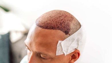 Warum Sie nach einer Haartransplantation auf Ibuprofen verzichten sollten