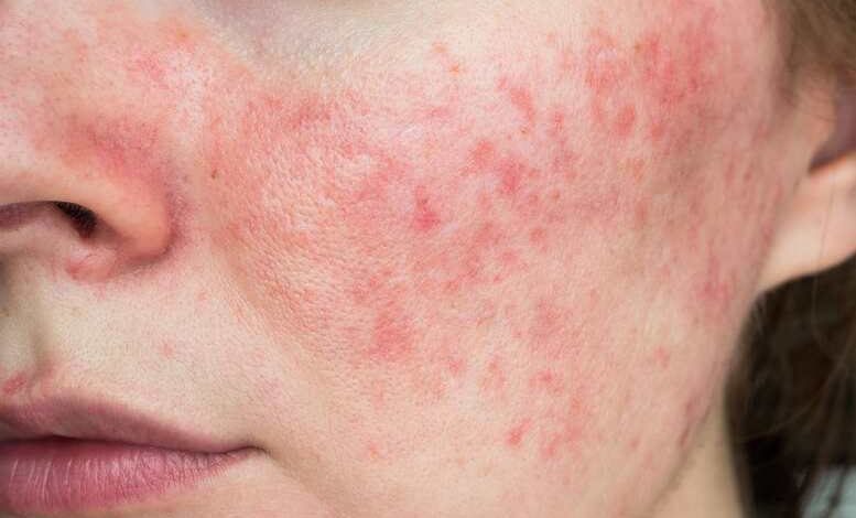 Ausschlag im Gesicht